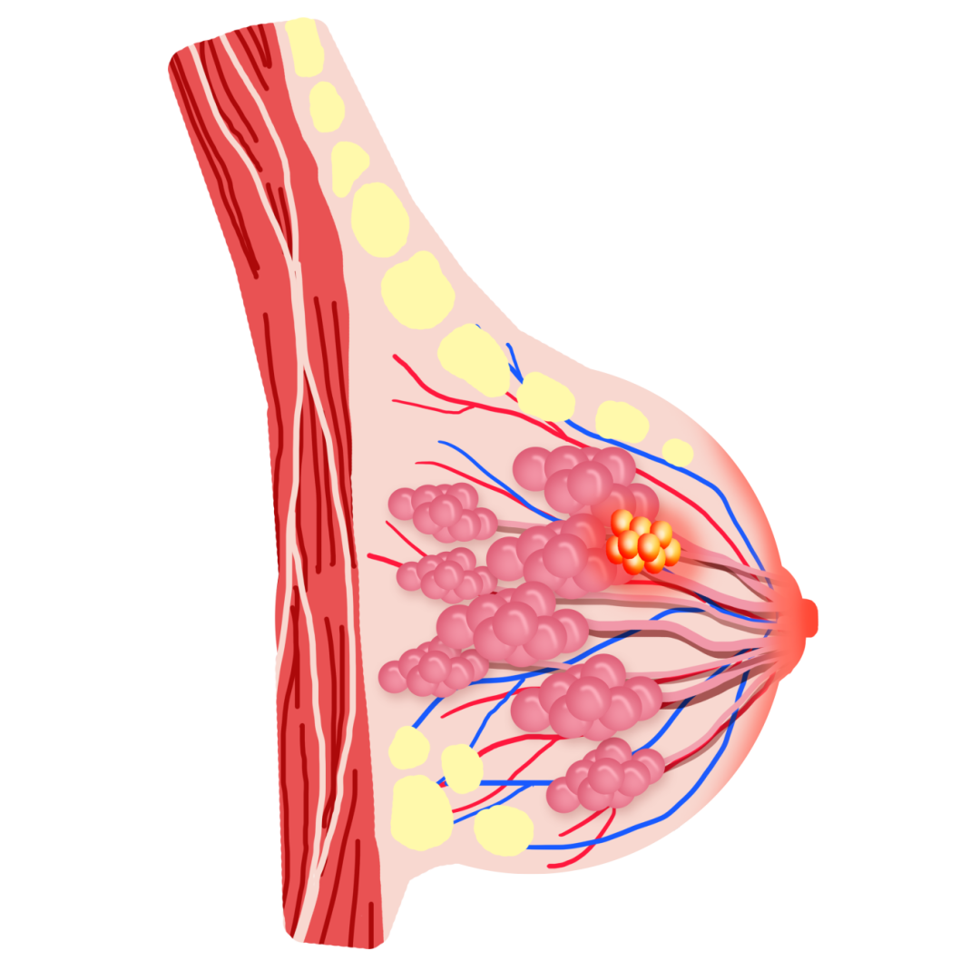 包圖網(wǎng)_19657413乳房腫瘤乳腺癌乳腺疾病 - 副本.png